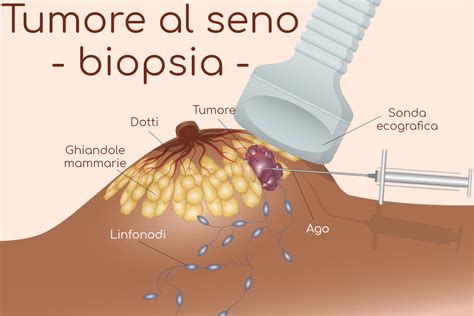 Illustrazione di diversi tipi di biopsia mammaria