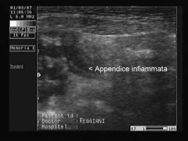 Immagine ecografica di un'appendice infiammata