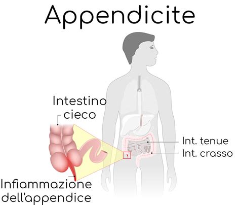 Schema comparativo tra sintomi di appendicite e colite