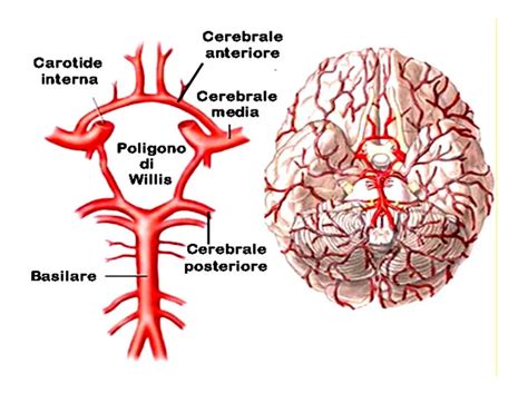 Schema che illustra la circolazione sanguigna cerebrale e le aree colpite da ictus