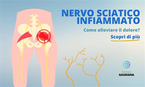 Illustrazione di un'ernia del disco lombare che comprime il nervo sciatico