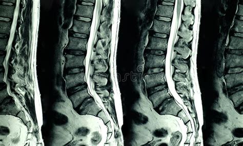 Immagine di una Risonanza Magnetica della colonna lombare