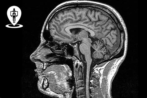 Immagine di una risonanza magnetica cerebrale