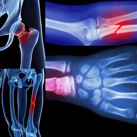 Immagine che illustra una frattura ossea