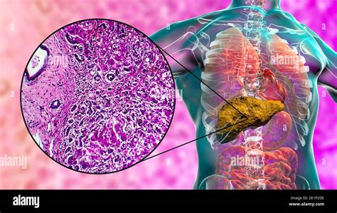Illustrazione microscopica di cellule epatiche sane e malate