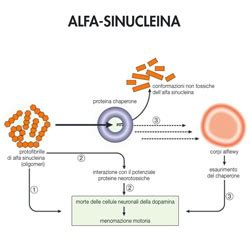 Rappresentazione schematica dell'accumulo di alfa-sinucleina nel cervello