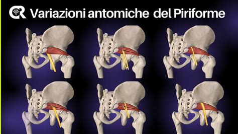 Illustrazione di posture che possono causare pressione sul muscolo piriforme