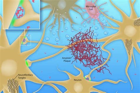 Illustrazione schematica delle placche amiloidi e dei grovigli neurofibrillari nel cervello affetto da Alzheimer