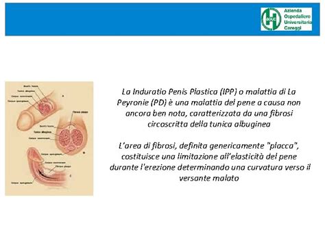Illustrazione dell'Induratio Penis Plastica e della formazione della placca